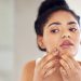 Acne Face Map: What Are Your Breakouts Telling You?